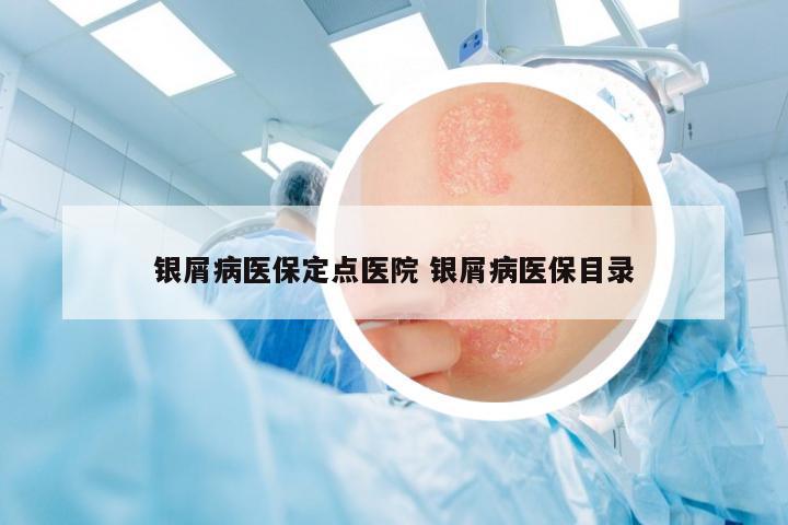 銀屑病醫(yī)保定點醫(yī)院 銀屑病醫(yī)保目錄