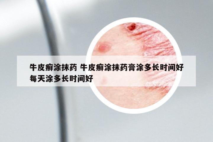 牛皮癬涂抹藥 牛皮癬涂抹藥膏涂多長時間好每天涂多長時間好
