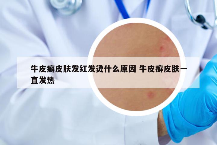 牛皮癬皮膚發(fā)紅發(fā)燙什么原因 牛皮癬皮膚一直發(fā)熱