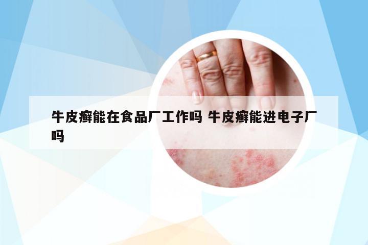 牛皮癬能在食品廠工作嗎 牛皮癬能進(jìn)電子廠嗎