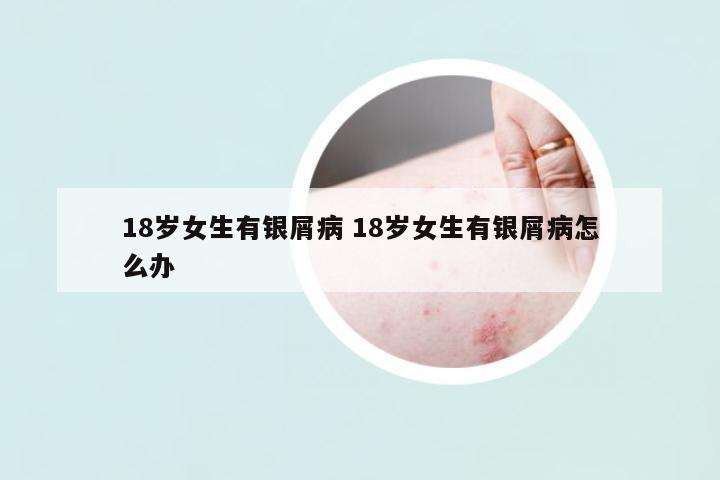 18歲女生有銀屑病 18歲女生有銀屑病怎么辦