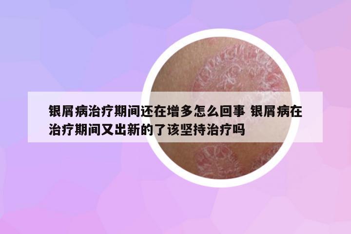 銀屑病治療期間還在增多怎么回事 銀屑病在治療期間又出新的了該堅(jiān)持治療嗎