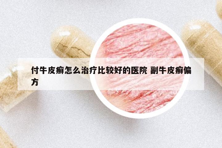 付牛皮癬怎么治療比較好的醫(yī)院 副牛皮癬偏方