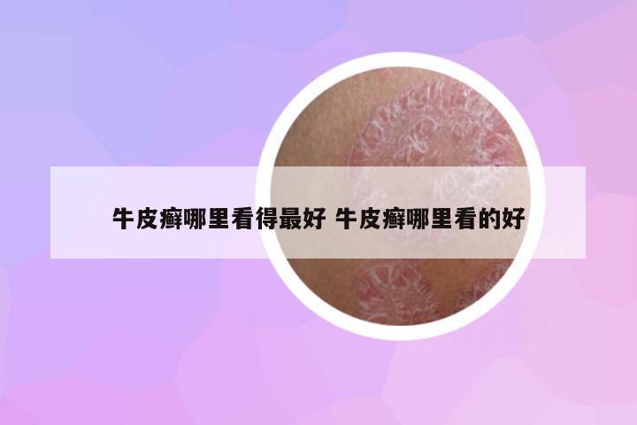 牛皮癬哪里看得最好 牛皮癬哪里看的好