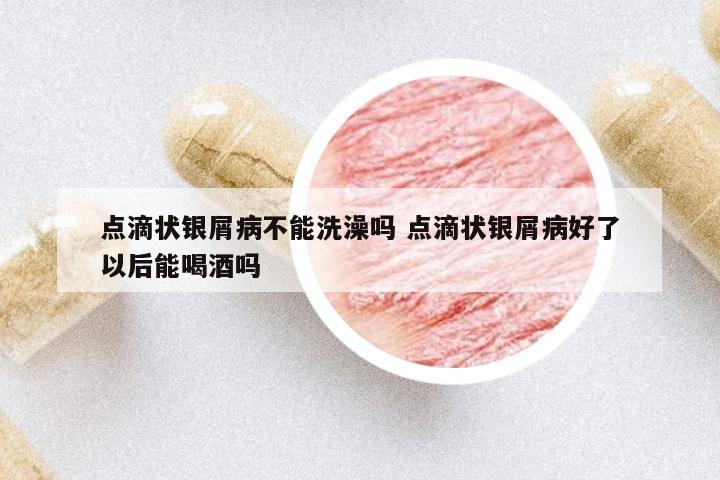 點滴狀銀屑病不能洗澡嗎 點滴狀銀屑病好了以后能喝酒嗎