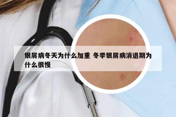 銀屑病冬天為什么加重 冬季銀屑病消退期為什么很慢