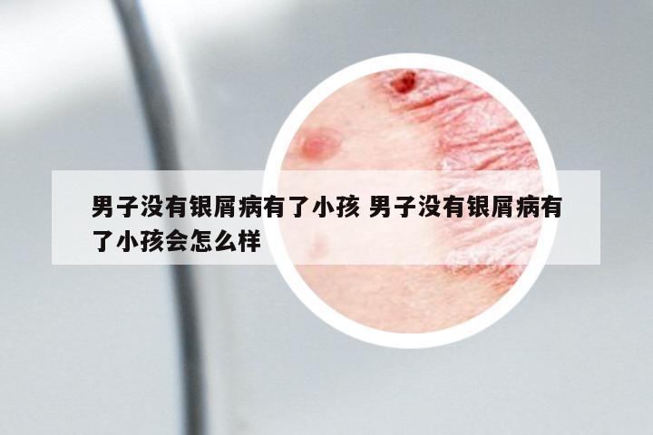 男子沒(méi)有銀屑病有了小孩 男子沒(méi)有銀屑病有了小孩會(huì)怎么樣