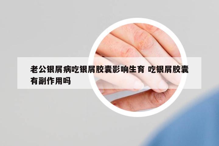 老公銀屑病吃銀屑膠囊影響生育 吃銀屑膠囊有副作用嗎