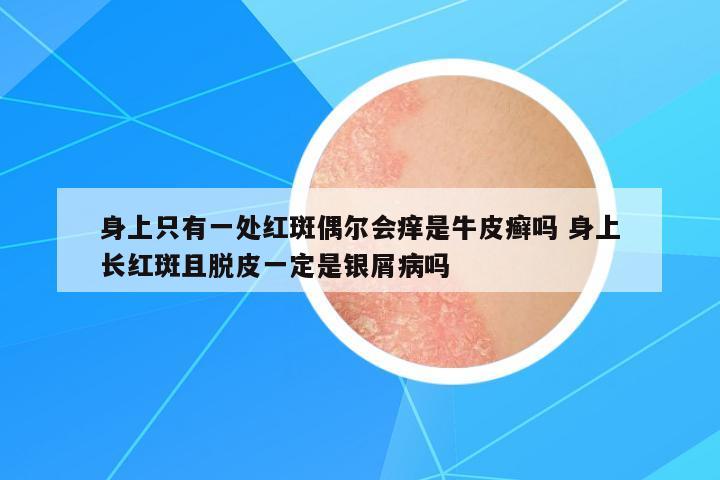 身上只有一處紅斑偶爾會(huì)癢是牛皮癬嗎 身上長(zhǎng)紅斑且脫皮一定是銀屑病嗎