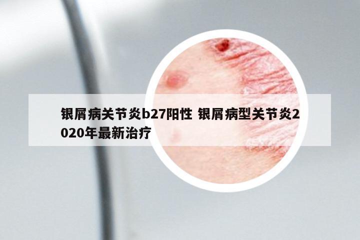 銀屑病關(guān)節(jié)炎b27陽性 銀屑病型關(guān)節(jié)炎2020年最新治療