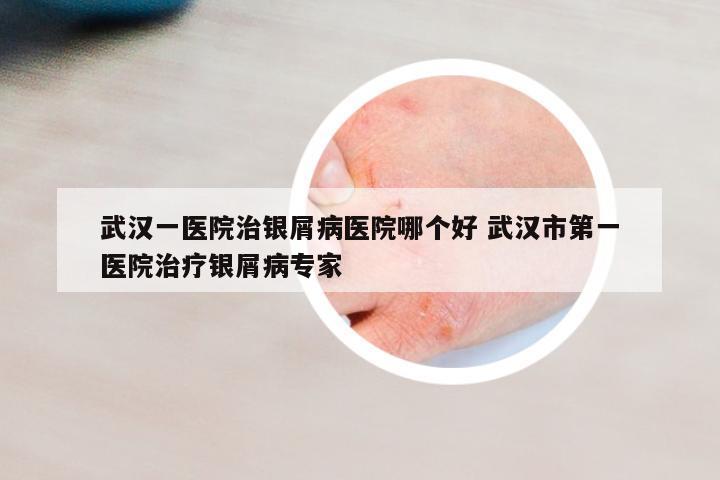 武漢一醫(yī)院治銀屑病醫(yī)院哪個(gè)好 武漢市第一醫(yī)院治療銀屑病專(zhuān)家