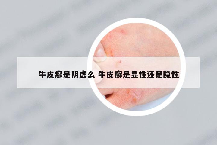 牛皮癬是陰虛么 牛皮癬是顯性還是隱性