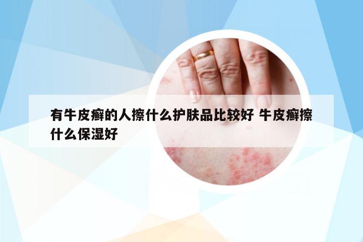 有牛皮癬的人擦什么護(hù)膚品比較好 牛皮癬擦什么保濕好