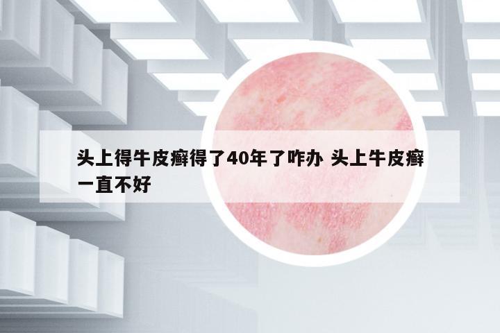 頭上得牛皮癬得了40年了咋辦 頭上牛皮癬一直不好