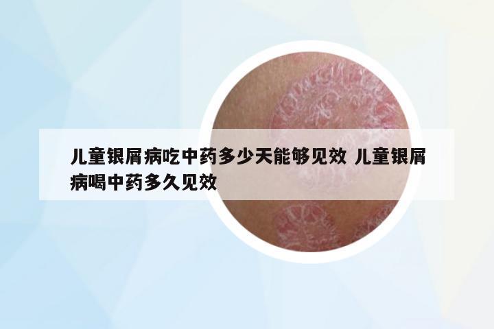 兒童銀屑病吃中藥多少天能夠見(jiàn)效 兒童銀屑病喝中藥多久見(jiàn)效