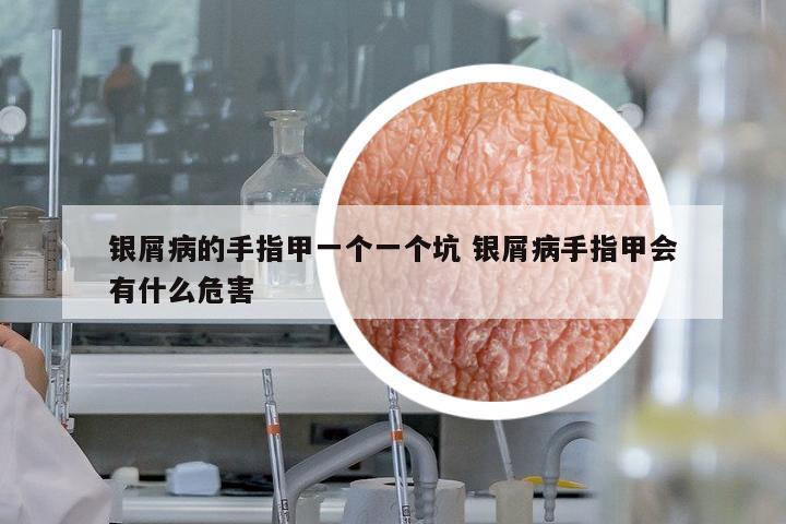 銀屑病的手指甲一個(gè)一個(gè)坑 銀屑病手指甲會(huì)有什么危害