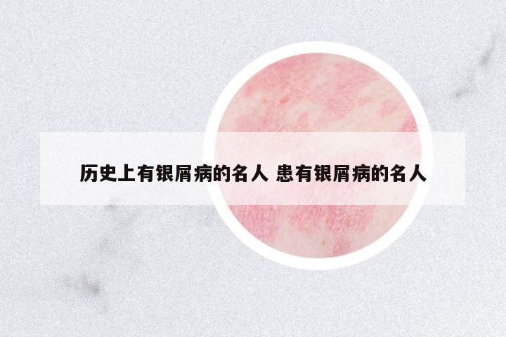 歷史上有銀屑病的名人 患有銀屑病的名人