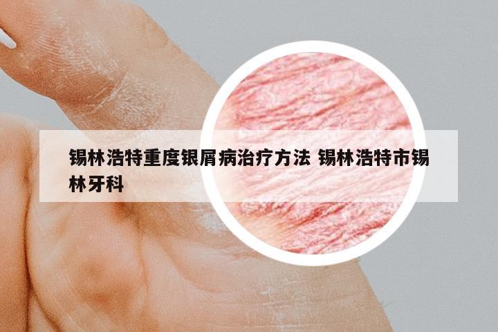 錫林浩特重度銀屑病治療方法 錫林浩特市錫林牙科
