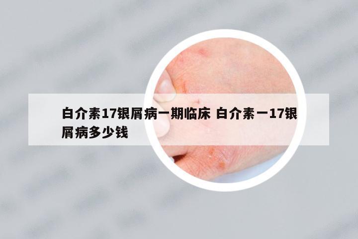 白介素17銀屑病一期臨床 白介素一17銀屑病多少錢
