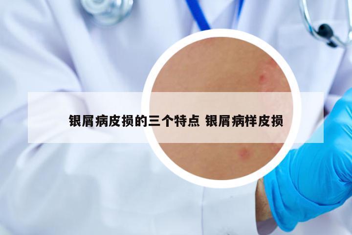 銀屑病皮損的三個特點 銀屑病樣皮損