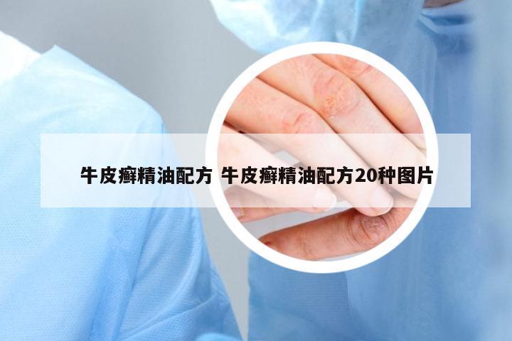 牛皮癬精油配方 牛皮癬精油配方20種圖片
