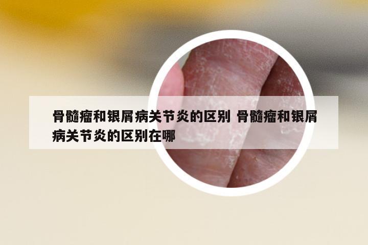 骨髓瘤和銀屑病關(guān)節(jié)炎的區(qū)別 骨髓瘤和銀屑病關(guān)節(jié)炎的區(qū)別在哪
