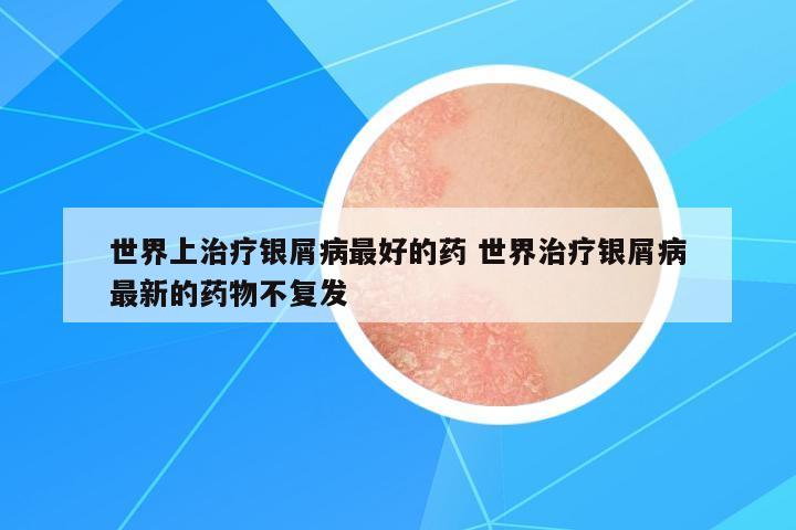 世界上治療銀屑病最好的藥 世界治療銀屑病最新的藥物不復發(fā)