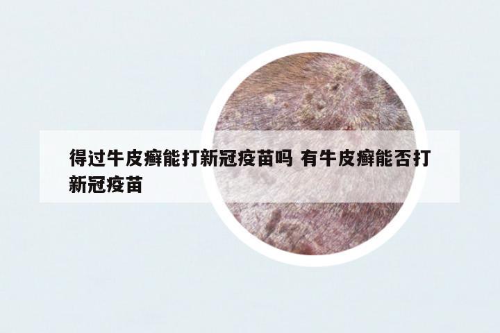 得過牛皮癬能打新冠疫苗嗎 有牛皮癬能否打新冠疫苗