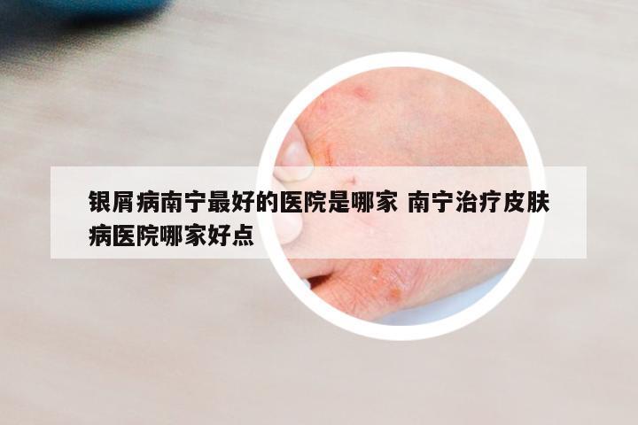銀屑病南寧最好的醫(yī)院是哪家 南寧治療皮膚病醫(yī)院哪家好點