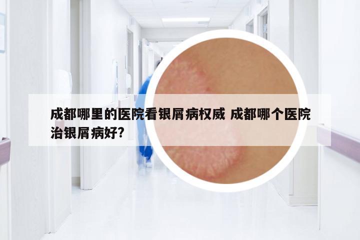 成都哪里的醫(yī)院看銀屑病權(quán)威 成都哪個(gè)醫(yī)院治銀屑病好?