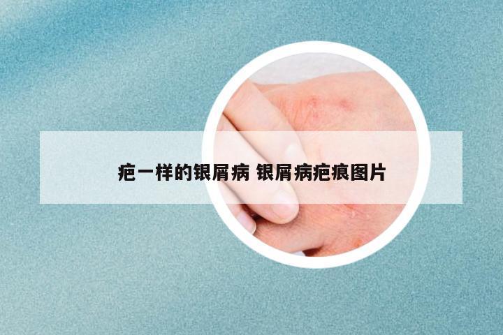 疤一樣的銀屑病 銀屑病疤痕圖片