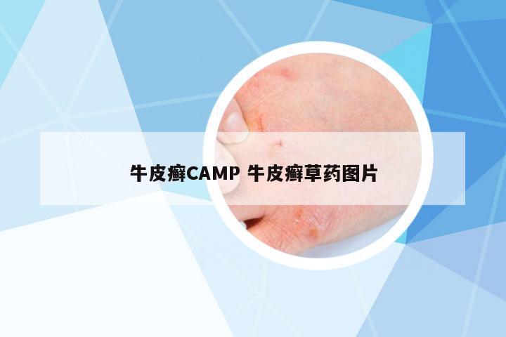 牛皮癬CAMP 牛皮癬草藥圖片