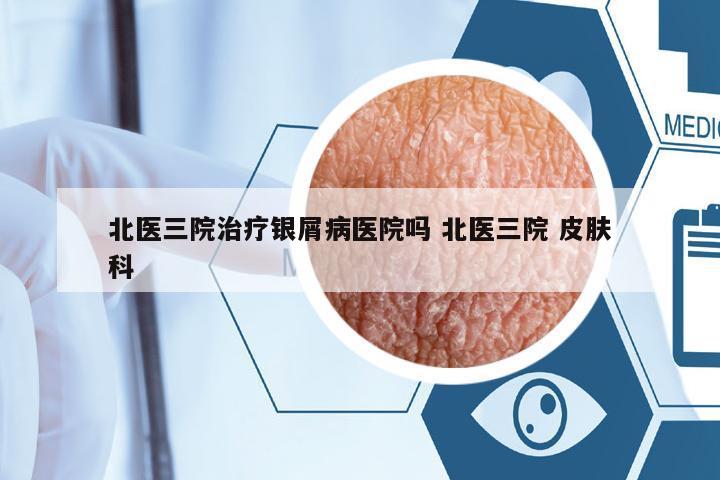 北醫(yī)三院治療銀屑病醫(yī)院嗎 北醫(yī)三院 皮膚科