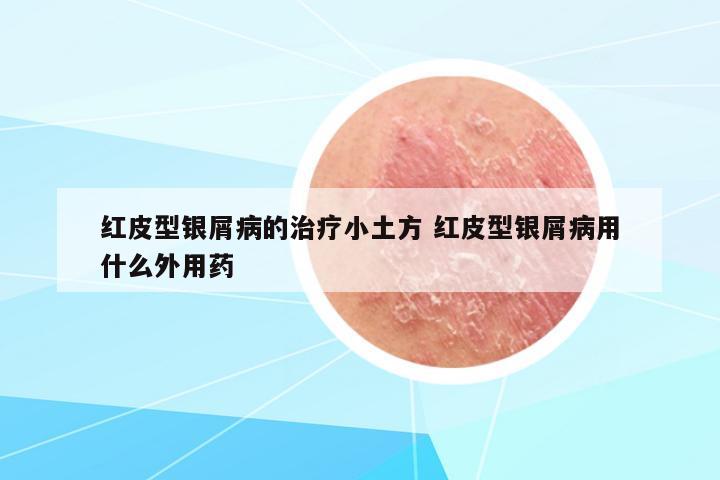 紅皮型銀屑病的治療小土方 紅皮型銀屑病用什么外用藥