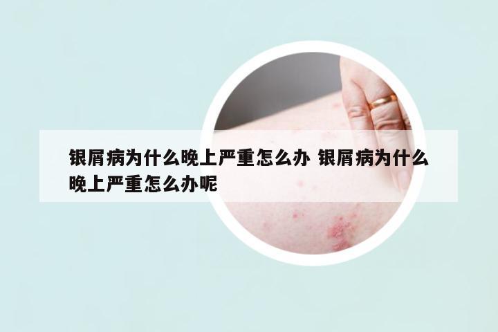 銀屑病為什么晚上嚴(yán)重怎么辦 銀屑病為什么晚上嚴(yán)重怎么辦呢
