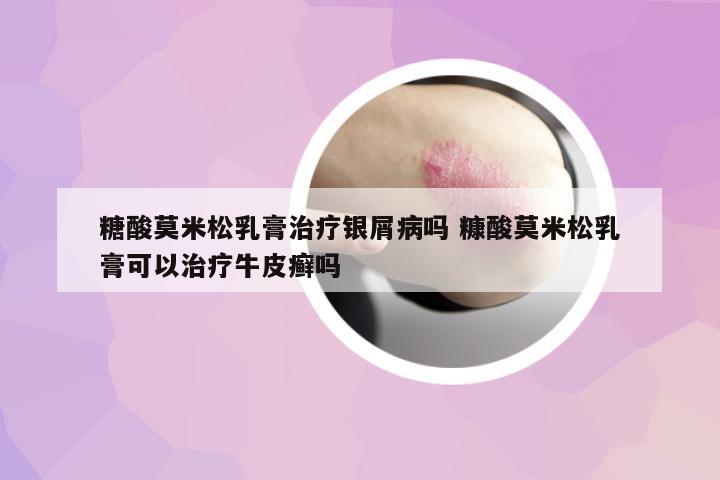 糖酸莫米松乳膏治療銀屑病嗎 糠酸莫米松乳膏可以治療牛皮癬嗎