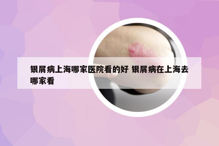 銀屑病上海哪家醫(yī)院看的好 銀屑病在上海去哪家看