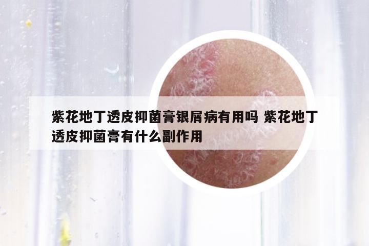紫花地丁透皮抑菌膏銀屑病有用嗎 紫花地丁透皮抑菌膏有什么副作用