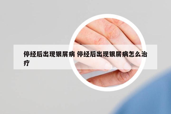 停經(jīng)后出現(xiàn)銀屑病 停經(jīng)后出現(xiàn)銀屑病怎么治療