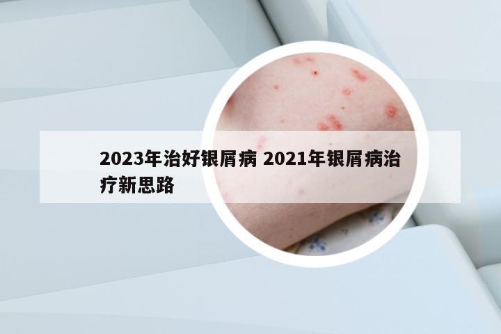 2023年治好銀屑病 2021年銀屑病治療新思路