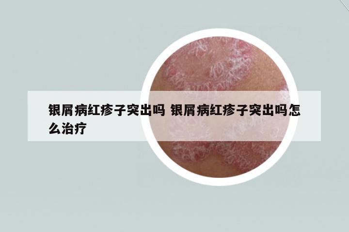 銀屑病紅疹子突出嗎 銀屑病紅疹子突出嗎怎么治療