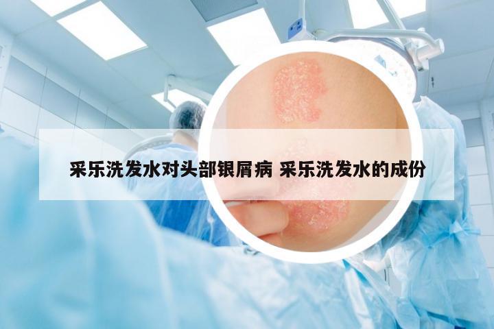 采樂洗發(fā)水對頭部銀屑病 采樂洗發(fā)水的成份