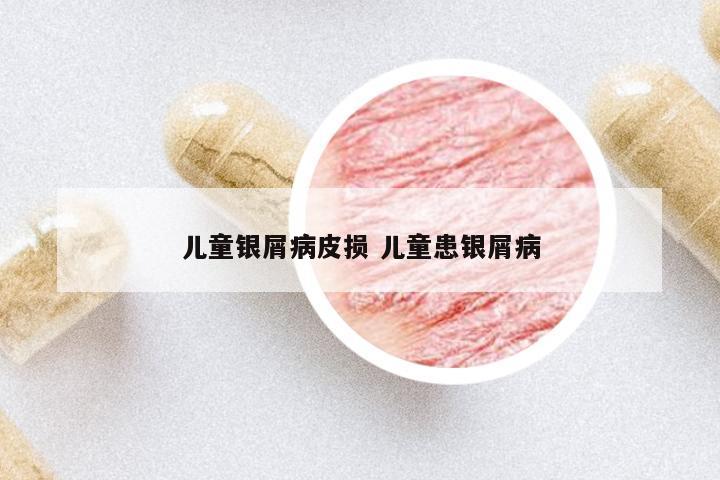 兒童銀屑病皮損 兒童患銀屑病