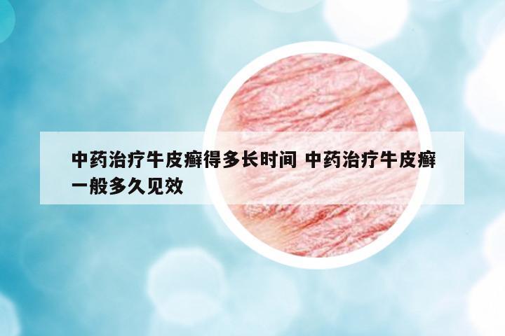 中藥治療牛皮癬得多長時間 中藥治療牛皮癬一般多久見效