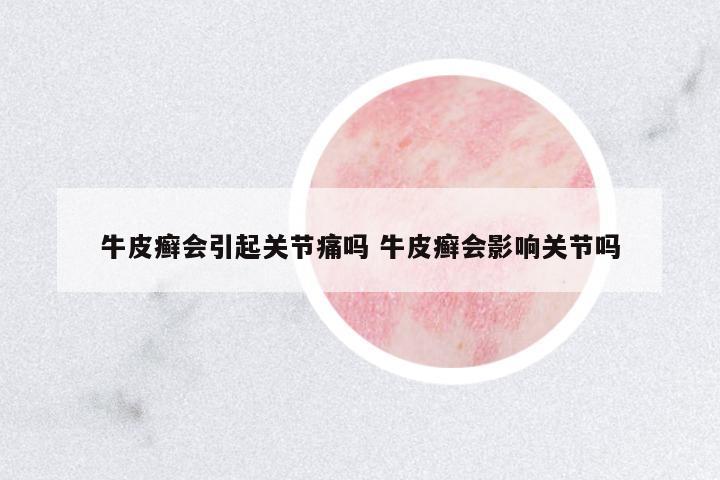 牛皮癬會引起關(guān)節(jié)痛嗎 牛皮癬會影響關(guān)節(jié)嗎