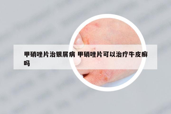 甲硝唑片治銀屑病 甲硝唑片可以治療牛皮癬嗎