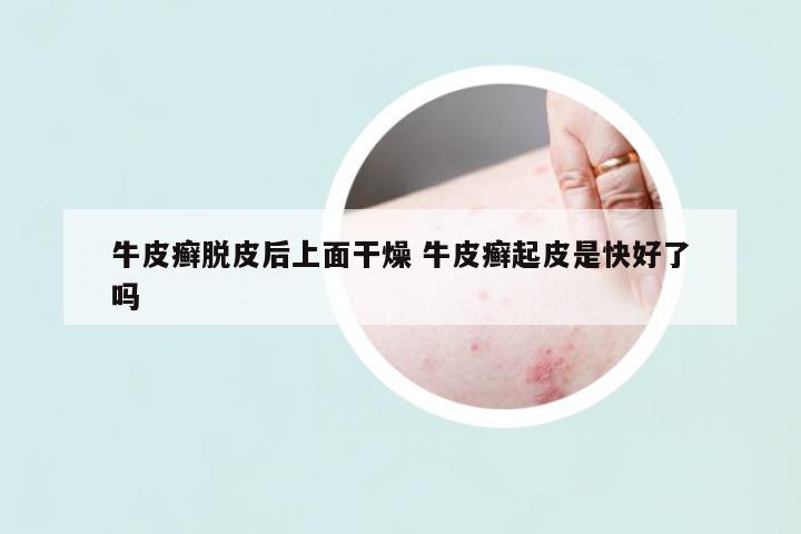 牛皮癬脫皮后上面干燥 牛皮癬起皮是快好了嗎