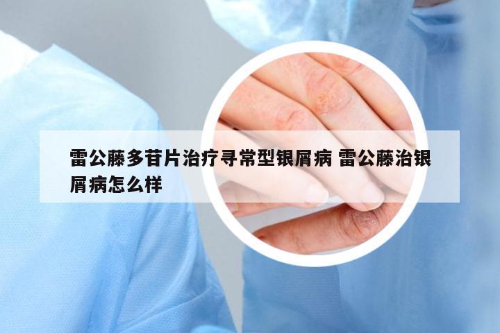 雷公藤多苷片治療尋常型銀屑病 雷公藤治銀屑病怎么樣