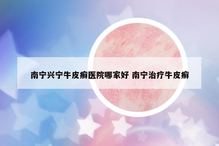 南寧興寧牛皮癬醫(yī)院哪家好 南寧治療牛皮癬