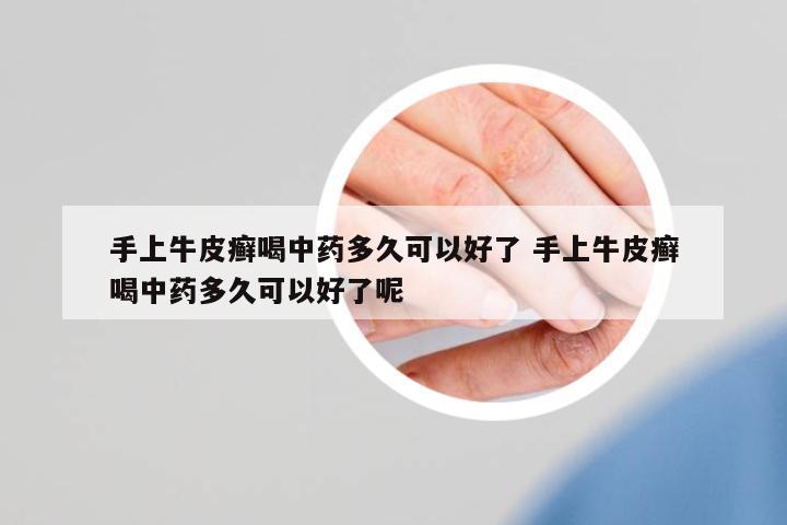 手上牛皮癬喝中藥多久可以好了 手上牛皮癬喝中藥多久可以好了呢